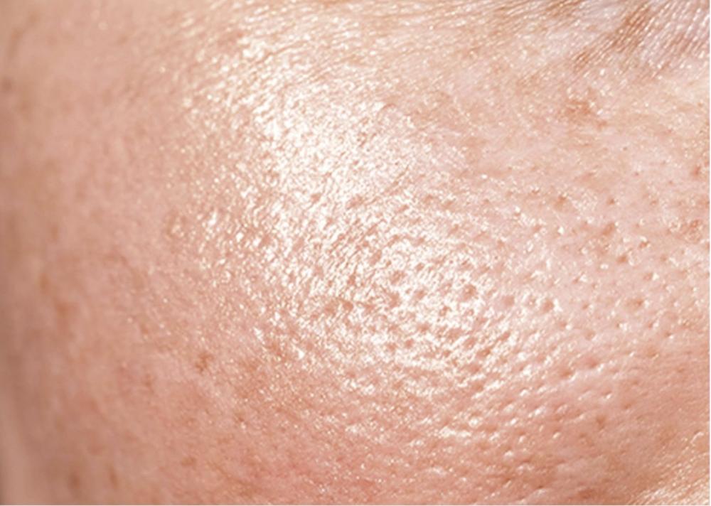 Piel con Brillo, grasa o sebo