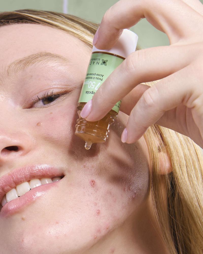 Joven con  Acné retencional (comedogénico) aplicanco en su rostro Ácido Salicílico 2% de Etat Pur